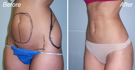 Cellulite-reduction-before-and-after