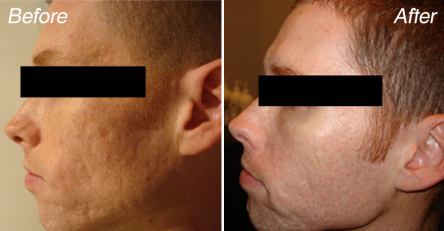 acne-scars-reduction-before-and-after