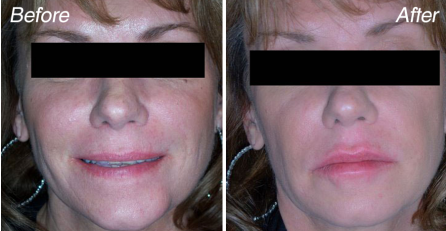 lip-injections-before-and-after