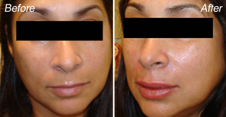liquid-facelift-before-and-after
