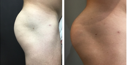 Sculptra-Butt-lift-before-and-after 3