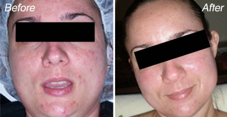 microdermabrasion-before-and-after
